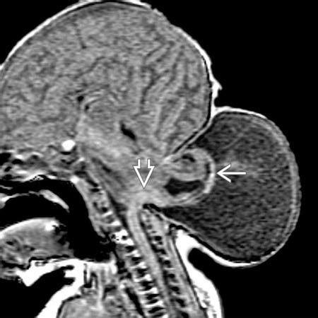 Chiari 3 | Radiology Key