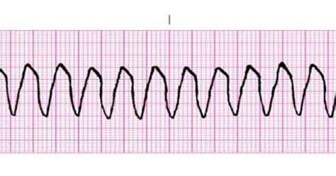 Dr. Smith's ECG Blog: Polymorphic Ventricular Tachycardia