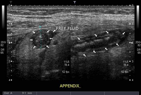 Appendicitis - Ultrasound - radRounds Radiology Network