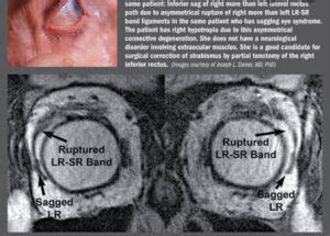 加齢性斜視~Sagging Eye 症候群~ | 上社眼科