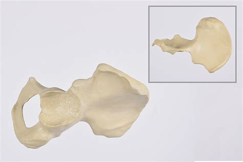 Hemi-Pelvis revision left - SYNBONE