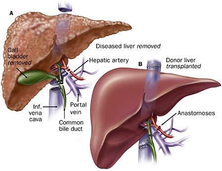 Liver Regeneration | Liver disease, Liver cancer, Liver