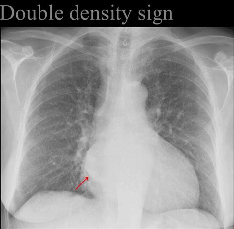 Double density sign Left atrial enlargement