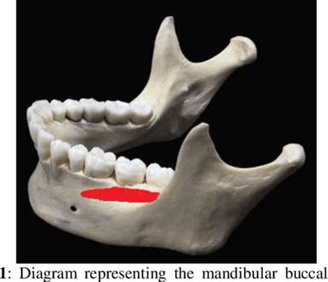 Figure 2 from Mandibular buccal shelf and infra zygomatic crest – A safe zone for miniscrew ...