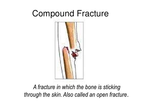 Staff Nurse Vacancy: Fractures Types Nursing Interventions