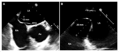 Transesophageal echocardiogram showed hypermobile interatrial septum.... | Download Scientific ...