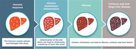 9 in 10 People With This Rare Liver Disease Are Women - SWHR