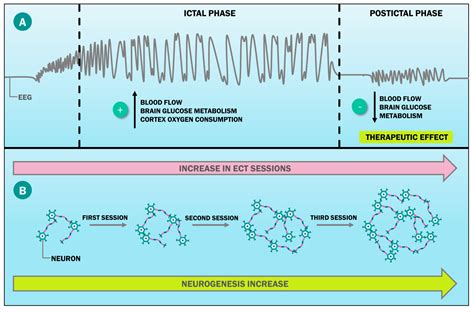 Electroconvulsive Therapy Diagram