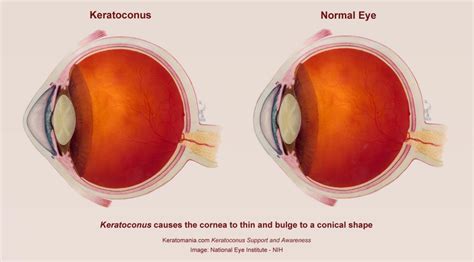 Keratoconus Treatment, Symptoms & Causes - Vue Vision