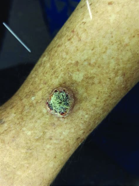 Squamous-cell carcinoma on the left forearm. | Download Scientific Diagram