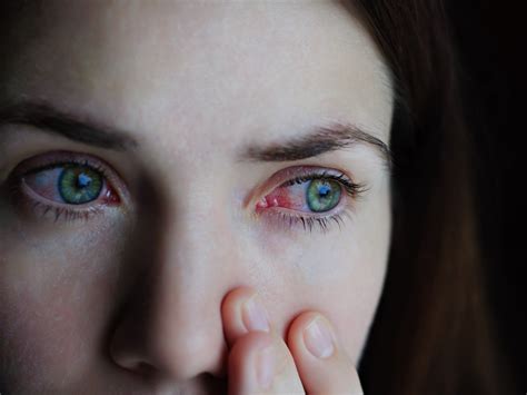 How to Get Rid of Stoned Eyes | Zinnia Health