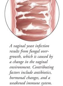 Vaginal Yeast Infection