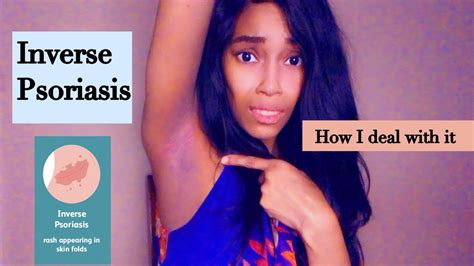 Inverse Psoriasis | what I go through & how I treat it - YouTube