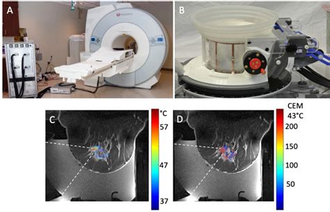 Focused Ultrasound as a Non-invasive Treatment for Breast Cancer – Discovery and Innovation at ...