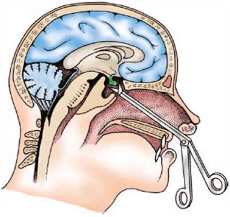 Hypophysectomy: Interventions | Med surg nursing, Nursing students, Med surg