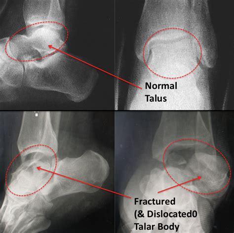 Talar Body Fracture - FootEducation