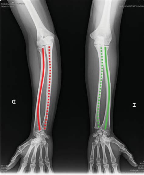 Frontal X-ray, with the longitudinal axis marked. Red for the right ...