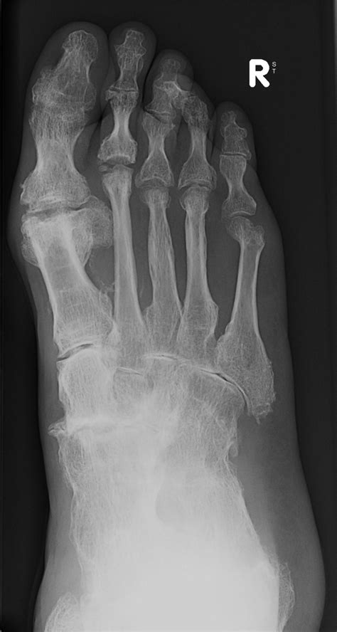 rheumatoid arthritis foot - The Podiatry Practice