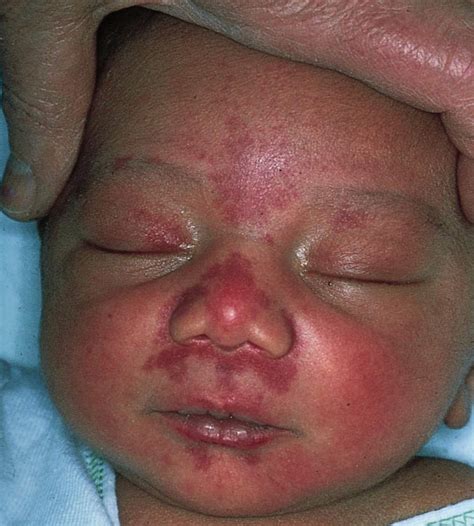 Study Medical Photos: Nevus Simplex Or A Salmon Patch - A Vascular Lesion Of Infancy