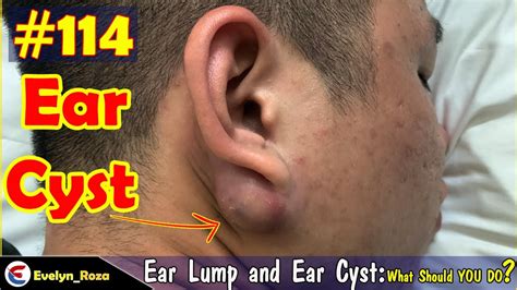 Removal Ear Lump and Ear Cyst | Acne Million views | Acne Treament #114 - YouTube