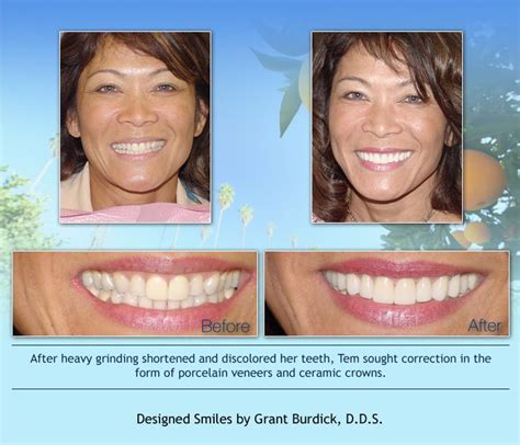 Cosmetic Dentistry: Before & After Photos http://www.designedsmiles.com ...