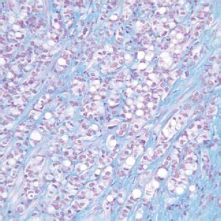 Urothelial carcinoma. Urothelial carcinoma in situ in a prostatic duct... | Download Scientific ...