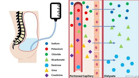 Peritoneal Dialysis - YouTube