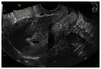 Avoiding misdiagnosing an early intrauterine pregnancy as an ectopic ...