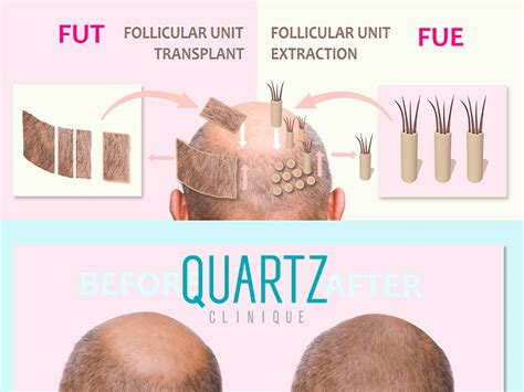 FUT Hair Transplant - Quartz Hair