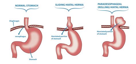 Hiatal Hernia - Types of hernia - Treatment / Hernia Surgery In Perth