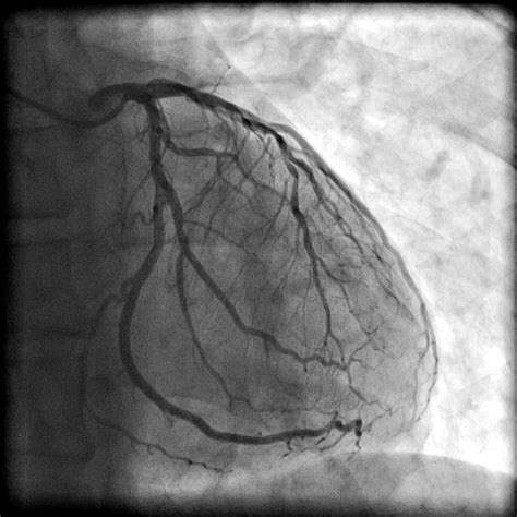 Angiogram/Cardiac Catheterization | SCAI - Seconds Count