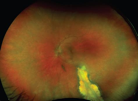 Current Diagnosis and Management of Uveitis