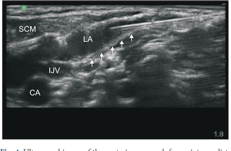 Cervical Plexus Ultrasound