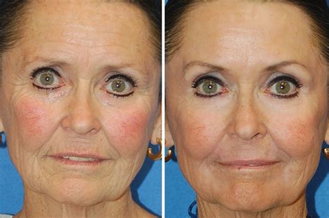 SCITON® Erbium Laser Skin Resurfacing | Napa Solano Plastic Surgery & MedSpa