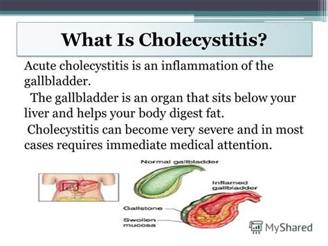 Chronic cholecystitis as related to Inflammation - Pictures