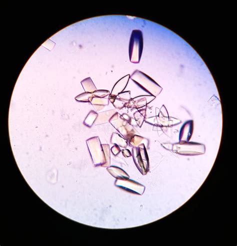 Uric Acid Crystals Images