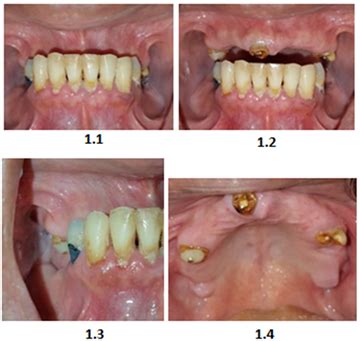 Tooth Supported Overdenture as an Amazing Solution for the Patient: A Case Report