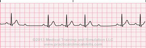 Conduction Disorders (PEARLS) - SMARTY PANCE