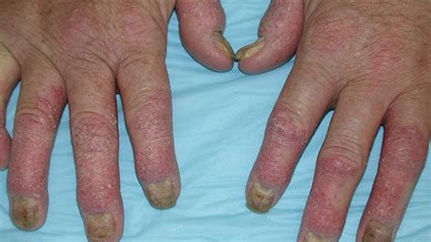 Psoriatic Arthritis Rash: Symptoms, Treatment, and More
