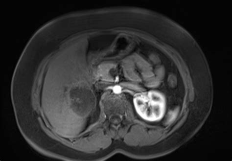 Hepatic hemangioma | Image | Radiopaedia.org