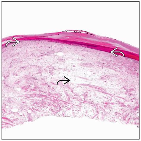 Digital Mucous Cyst | Basicmedical Key