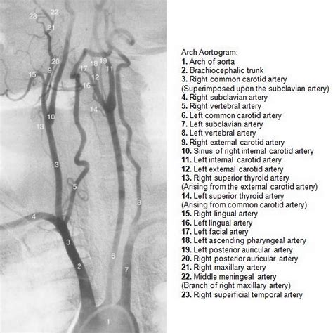 Dr Balaji Anvekar FRCR: Normal Neck Angiogram DSA