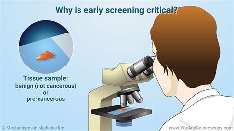 Slide Show - When should I get a colonoscopy and what do the results mean?