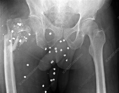 Firearm injury, X-ray - Stock Image - C003/7301 - Science Photo Library