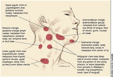 Very Swollen Lymph Nodes In Neck