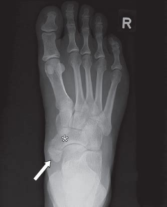 Common accessory ossicles of the foot: imaging features, pitfalls and associated pathology | SMJ