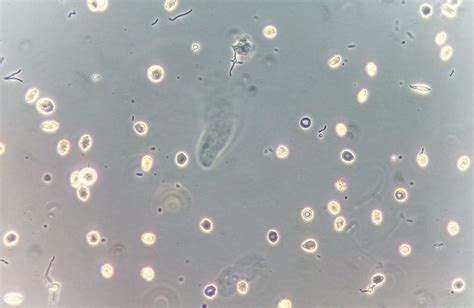 Urine Sediment of the Month: Bacterial Variant Forms - Renal Fellow Network