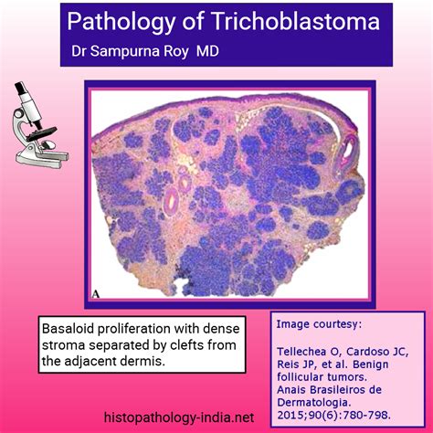 Pathology of Trichoblastoma #dermatopathology #dermpath | Pathology ...