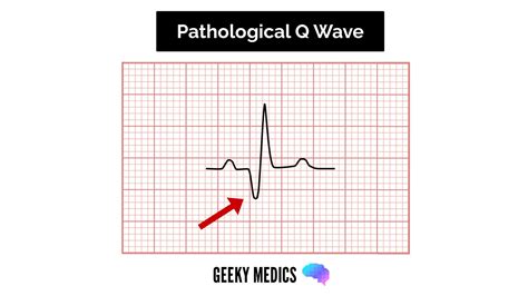 Pathological Q Waves Ecg / Cariology: W1D1AM at Wake Forest University ...