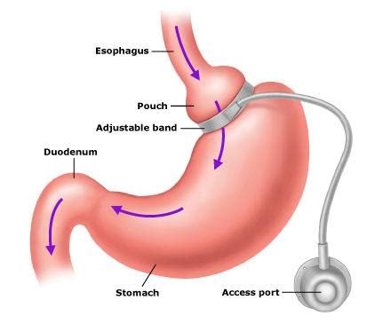 LAP-BAND Surgery: Benefits, Risks & Cost » How To Relief